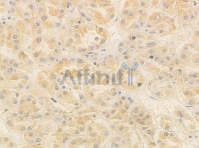 CHES1 Antibody - DF13903 at 1/100 staining human renal cell carcinoma by IHC-P.
