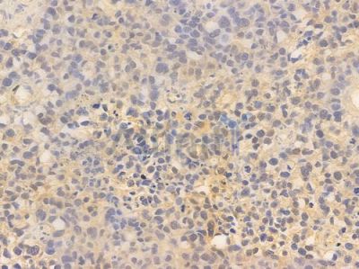 BRF2 Antibody - DF13924 at 1/100 staining human glioblastoma by IHC-P.