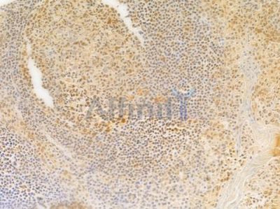 Sohlh2 Antibody - DF14179 at 1/100 staining human tongue carcinoma by IHC-P.