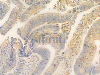 ORMDL3 Antibody - DF14231 at 1/100 staining human colon carcinoma by IHC-P.