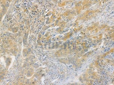 PGS1 Antibody - DF14440 at 1/100 staining human lung squamous cell carcinoma by IHC-P.
