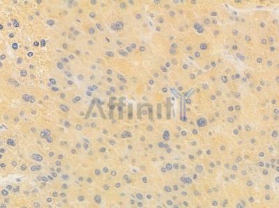 ART1 Antibody - DF14645 at 1/100 staining human hepatocellular carcinoma by IHC-P.