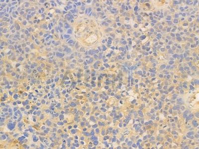 SRI Antibody - DF14648 at 1/100 staining human glioblastoma by IHC-P.