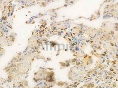 PES1 Antibody - DF14659 at 1/100 staining human lung squamous cell carcinoma by IHC-P.