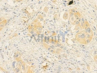 FAM129B Antibody - DF14676 at 1/100 staining human tongue carcinoma by IHC-P.