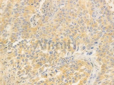 CARS2 Antibody - DF14691 at 1/100 staining human lung squamous cell carcinoma by IHC-P.