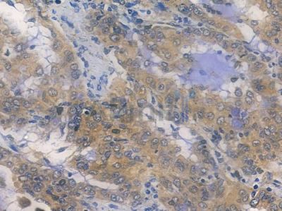 ZC4H2 Antibody - DF14896 at 1/100 staining human lung adenocarcinoma by IHC-P.