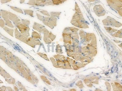 ZC3H12C Antibody - DF14899 at 1/100 staining human tongue carcinoma by IHC-P.