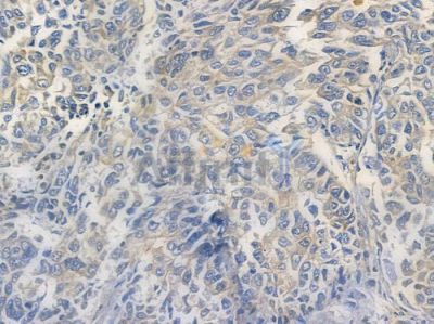 C1orf43 Antibody - DF14945 at 1/100 staining human lung squamous cell carcinoma by IHC-P.
