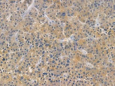 MATN1 Antibody - DF14972 at 1/100 staining human hepatocellular carcinoma by IHC-P.