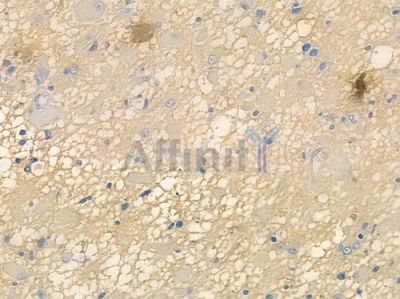 TMEM38B Antibody - DF14974 at 1/100 staining human astrocytoma by IHC-P.
