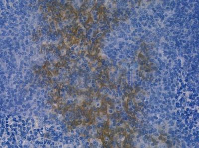 DNAJC14 Antibody - DF15105 at 1/100 staining human tongue carcinoma by IHC-P.