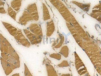 PARM1 Antibody - DF15184 at 1/100 staining human tongue carcinoma by IHC-P.