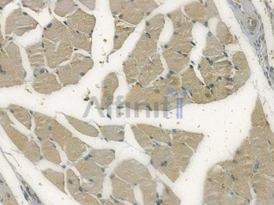 RSPH3 Antibody - DF15196 at 1/100 staining human tongue carcinoma by IHC-P.