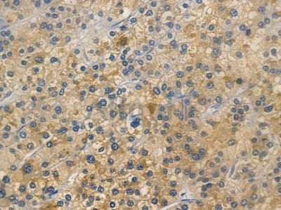 SELENOT Antibody - DF15201 at 1/100 staining human hepatocellular carcinoma by IHC-P.