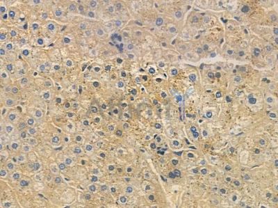 OR2AK2 Antibody - DF15233 at 1/100 staining human hepatocellular carcinoma by IHC-P.