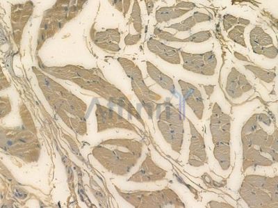 OR2D2 Antibody - DF15234 at 1/100 staining human tongue carcinoma by IHC-P.