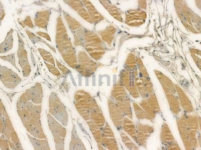 GPX2 Antibody - DF15267 at 1/100 staining human tongue carcinoma by IHC-P.