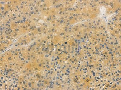 TRIB1 Antibody - DF15274 at 1/100 staining human hepatocellular carcinoma by IHC-P.