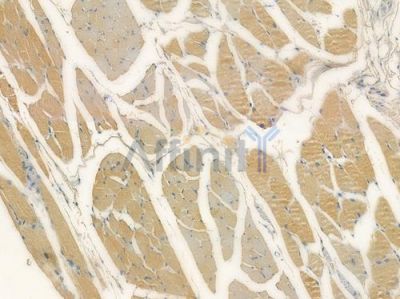 PRICKLE1 Antibody - DF15279 at 1/100 staining human tongue carcinoma by IHC-P.