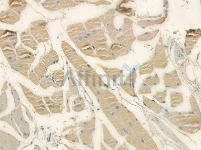 RILP Antibody - DF15290 at 1/100 staining human tongue carcinoma by IHC-P.