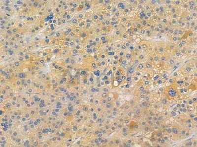 TIMMDC1 Antibody - DF15317 at 1/100 staining human hepatocellular carcinoma by IHC-P.