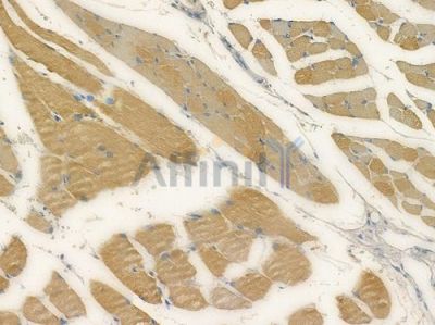 MOXD1 Antibody - DF15325 at 1/100 staining human tongue carcinoma by IHC-P.