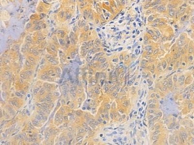 TPCN1 Antibody - DF16053 at 1/100 staining human lung adenocarcinoma by IHC-P.