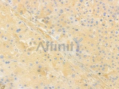 UROS Antibody - DF16065 at 1/100 staining human hepatocellular carcinoma by IHC-P.