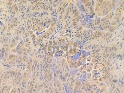 DDX3Y Antibody - DF16083 at 1/100 staining human lung adenocarcinoma by IHC-P.