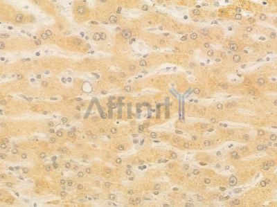 XYLB Antibody - DF16104 at 1/100 staining human hepatocellular carcinoma by IHC-P.