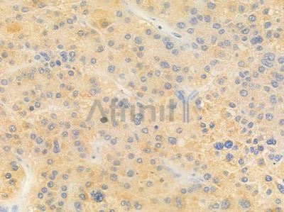 CCAR1 Antibody - DF2281 at 1/100 staining human hepatocellular carcinoma by IHC-P.
