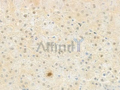 GFI1B Antibody - DF2409 at 1/100 staining human gastric carcinoma by IHC-P.