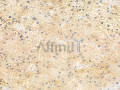 CPEB1 Antibody - DF2462 at 1/100 staining human hepatocellular carcinoma by IHC-P.