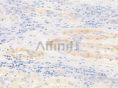 Cytochrome P450 3A43 Antibody - DF2617 at 1/100 staining human hepatocellular carcinoma by IHC-P.