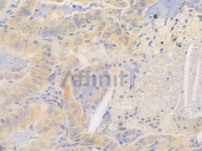 NEK2 Antibody - DF2669 at 1/100 staining human lung adenocarcinoma by IHC-P.