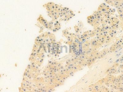 GPR25 Antibody - DF2733 at 1/100 staining human hepatocellular carcinoma by IHC-P.
