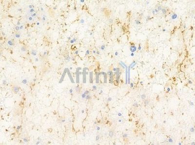 GPR6 Antibody - DF2754 at 1/100 staining human astrocytoma by IHC-P.