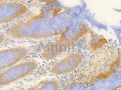 GPR86/GPR94 Antibody - DF2770 at 1/100 staining human colon carcinoma by IHC-P.