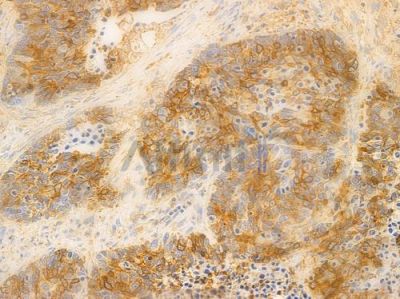 STAT5 Antibody - DF3635 at 1/100 staining human large cell lung carcinoma by IHC-P.