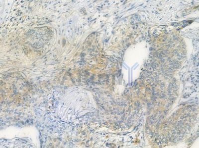 DHODH Antibody - DF3991 at 1/100 staining human cervical carcinoma by IHC-P.