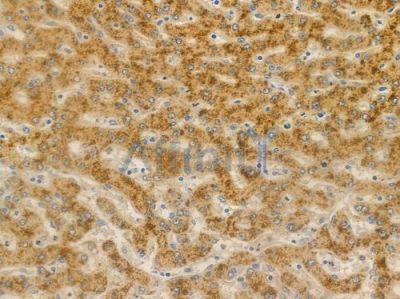 GJC2 Antibody - DF4078 at 1/100 staining human hepatocellular carcinoma by IHC-P.