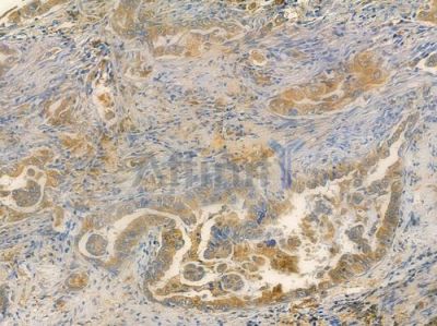 RAB6A Antibody - DF4407 at 1/100 staining human lung adenocarcinoma by IHC-P.