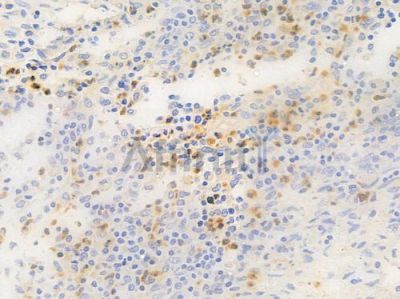 EPHB1 Antibody - DF4780 at 1/100 staining human colon carcinoma by IHC-P.