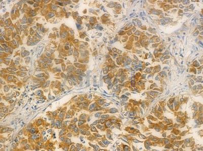 BTLA Antibody - DF4812 at 1/100 staining human lung squamous cell carcinoma by IHC-P.