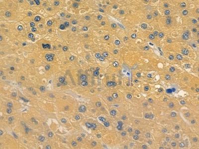 5HT2C Receptor Antibody - DF4846 at 1/100 staining human hepatocellular carcinoma by IHC-P.