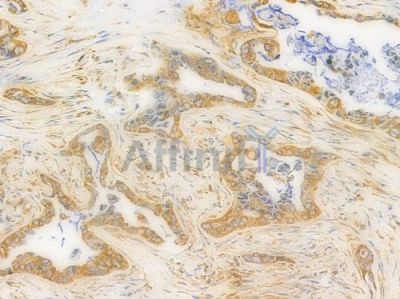 GRP94 Antibody - DF6171 at 1/100 staining human pancreatic carcinoma by IHC-P.