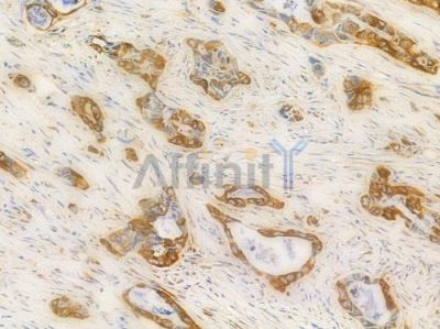 PDIA3 Antibody - DF6230 at 1/100 staining human pancreatic carcinoma by IHC-P.
