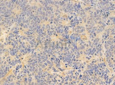 IL18 Antibody - DF6252 at 1/100 staining human small cell lung carcinoma by IHC-P.