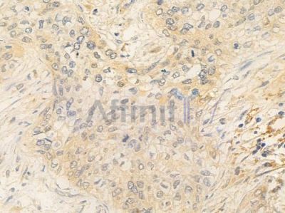 Emerin Antibody - DF6266 at 1/100 staining human cervical carcinoma by IHC-P.